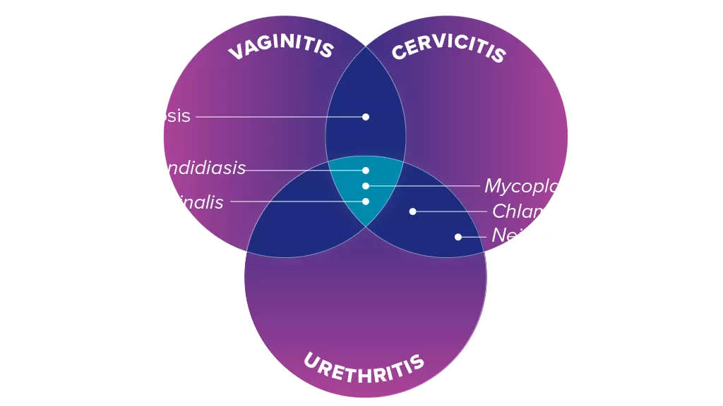 Illustration of symptoms of Vaginitis Cervicitis Urethritis